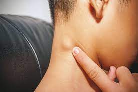 Head and Neck Tumor Diseases